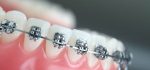 ارتودنسی چیست | آیا ارتودنسی باعث تحلیل ریشه دندان می شود؟