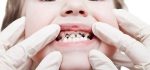 علت پوسیدگی دندان و پیشگیری از پوسیدگی دندان