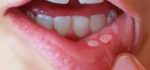 درمان آفت های دهانی با شیر نارگیل + عکس ها